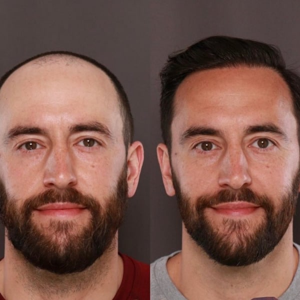 Before after FUT or Strip Method Hair Transplants Roy & Draper UT