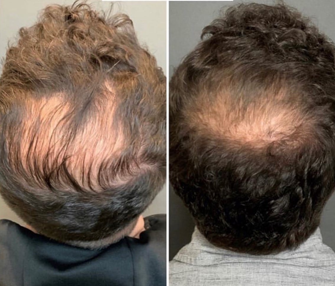 finasteride results Before after finasteride Roy & Draper UT