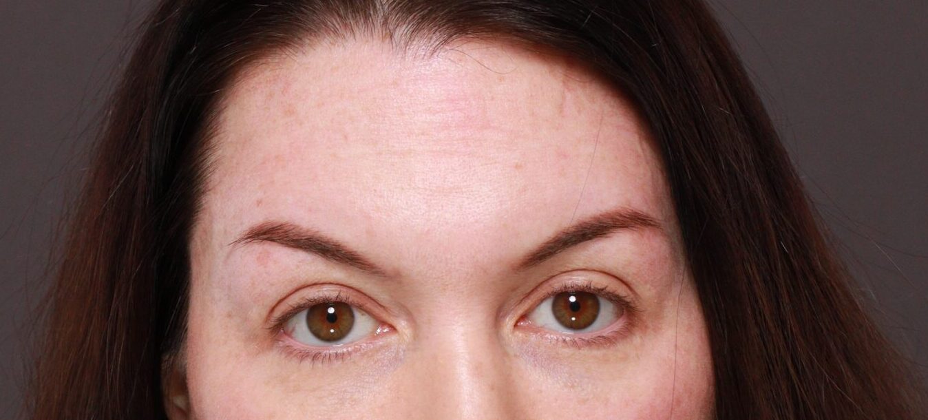 Before Image: Eyebrow Hair Transplant by Dr. Manning - front