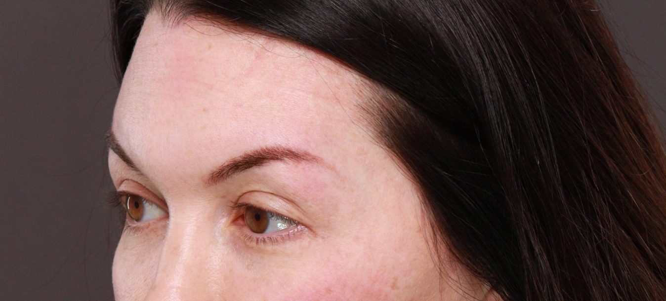 Before Image: Eyebrow Hair Transplant by Dr. Manning - left-front-oblique