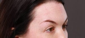 Eyebrow Hair Transplant by Dr. Manning