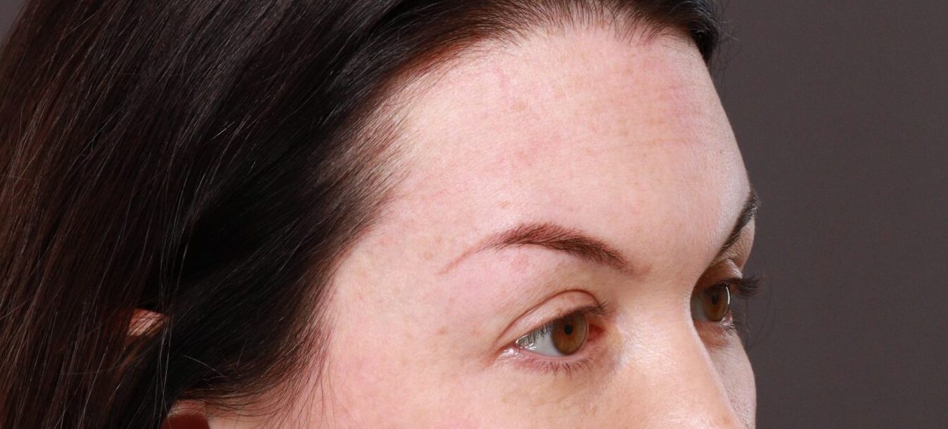 Before Image: Eyebrow Hair Transplant by Dr. Manning - right-front-oblique