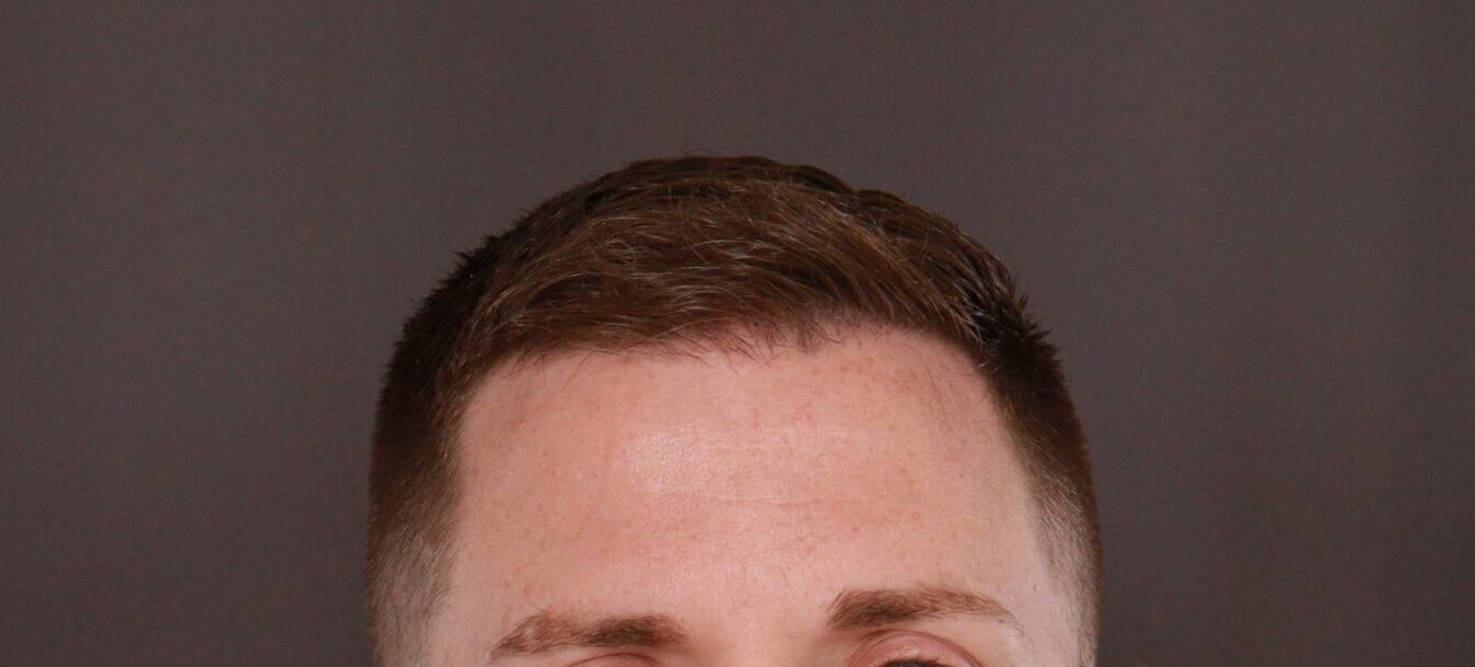 After Image: FUE Hair Transplant by Dr. Thompson - front