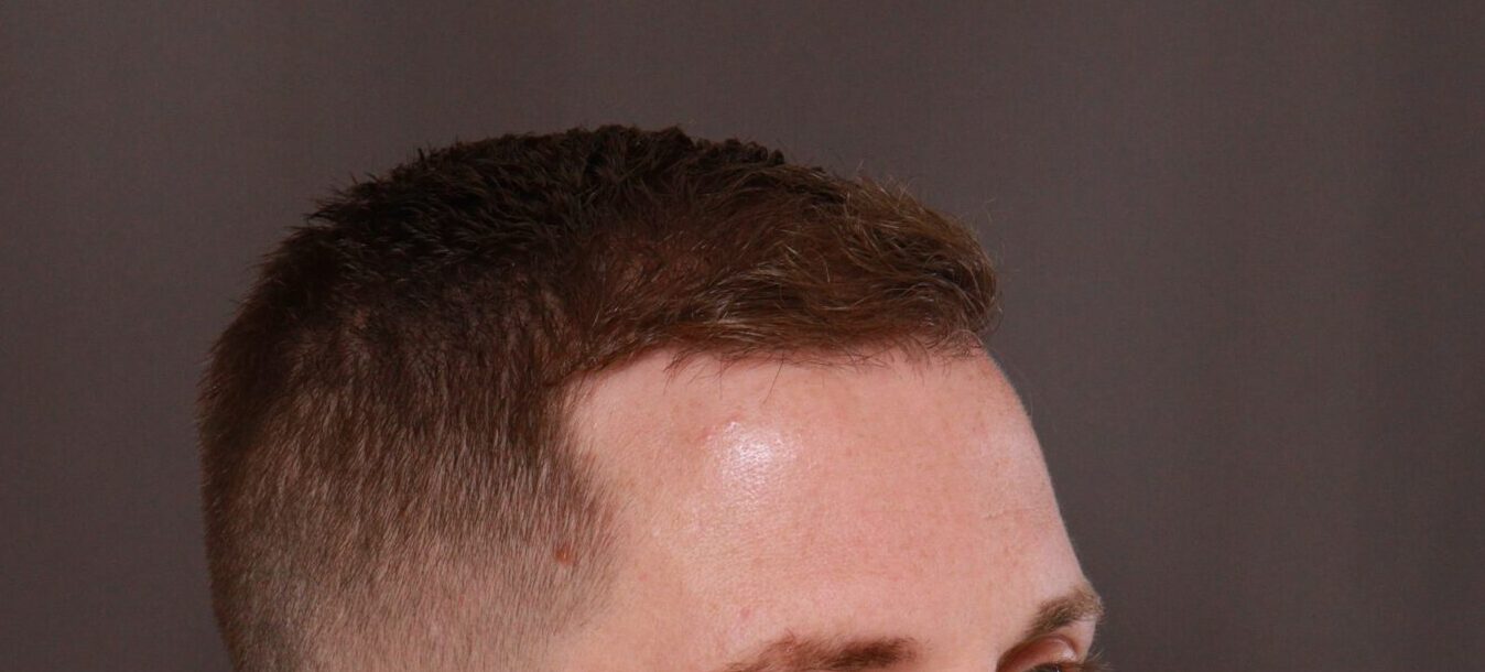 After Image: FUE Hair Transplant by Dr. Thompson - right-front-oblique
