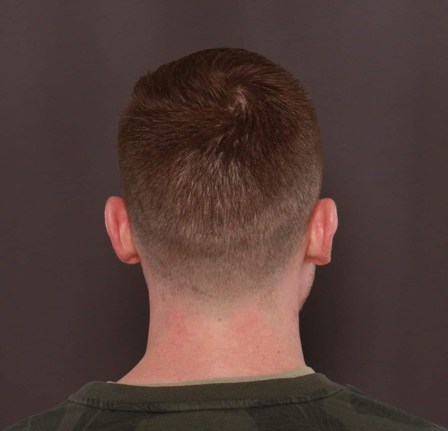 After Image: FUE Hair Transplant by Dr. Thompson - back