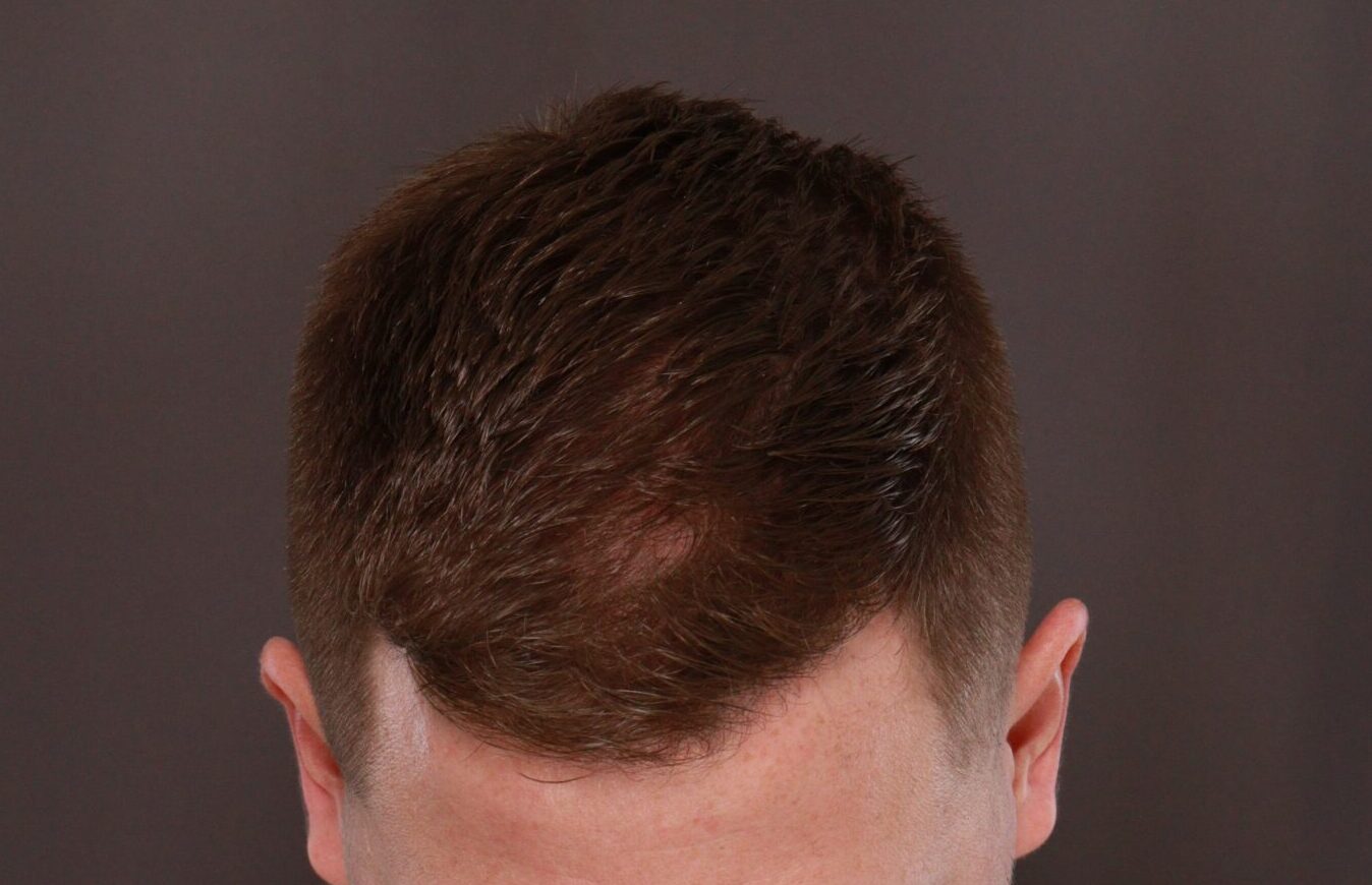 After Image: FUE Hair Transplant by Dr. Thompson - front