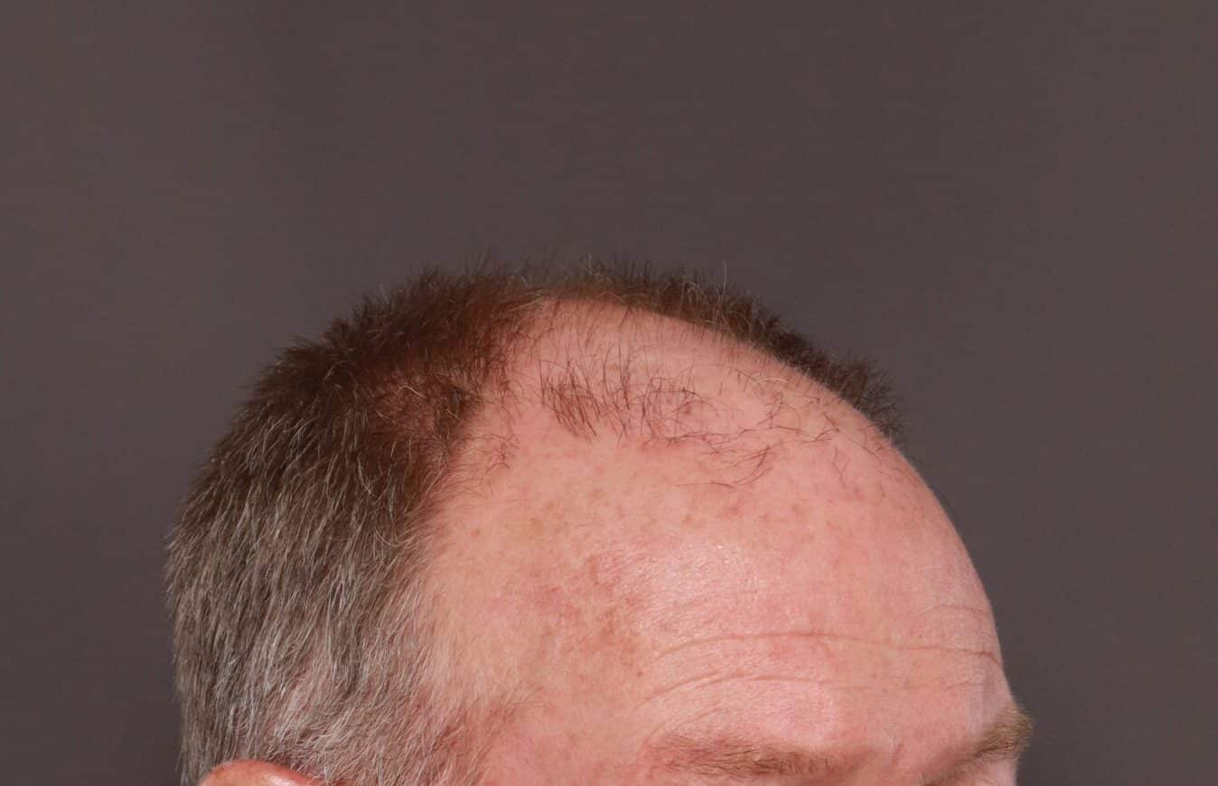 Before Image: FUT Hair Transplant by Dr. Manning - right-front-oblique