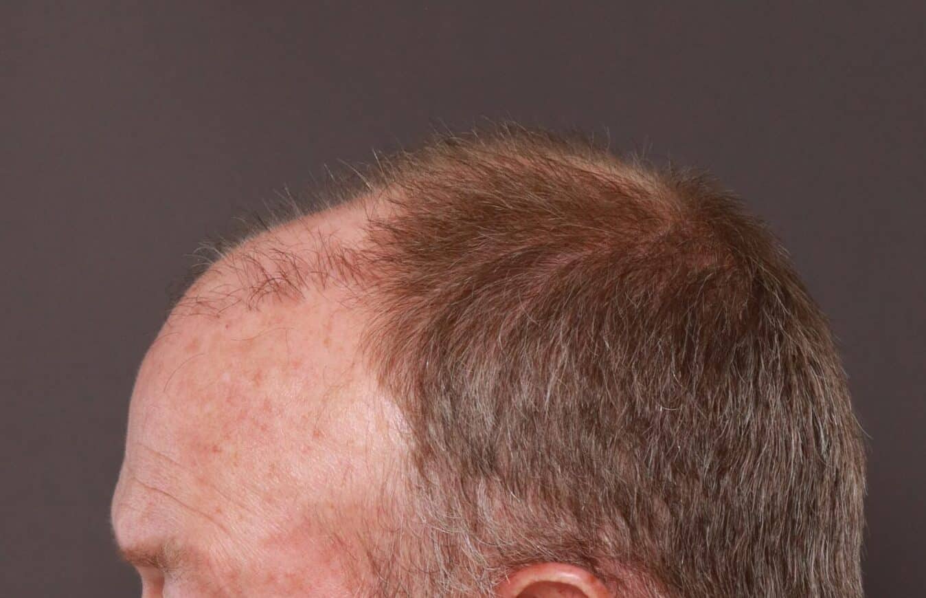 Before Image: FUT Hair Transplant by Dr. Manning -