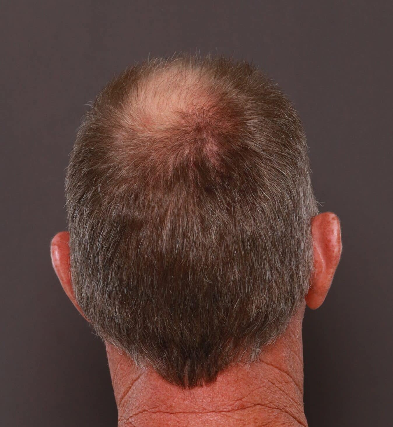 Before Image: FUT Hair Transplant by Dr. Manning - front