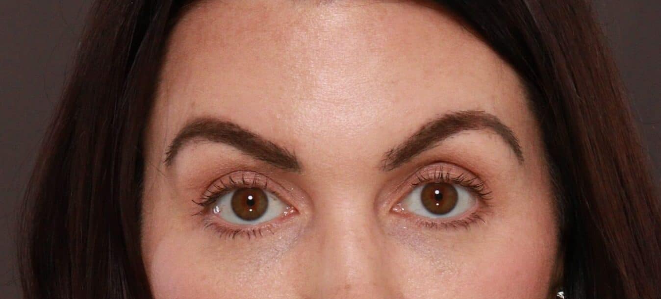 After Image: Eyebrow Hair Transplant by Dr. Manning - front