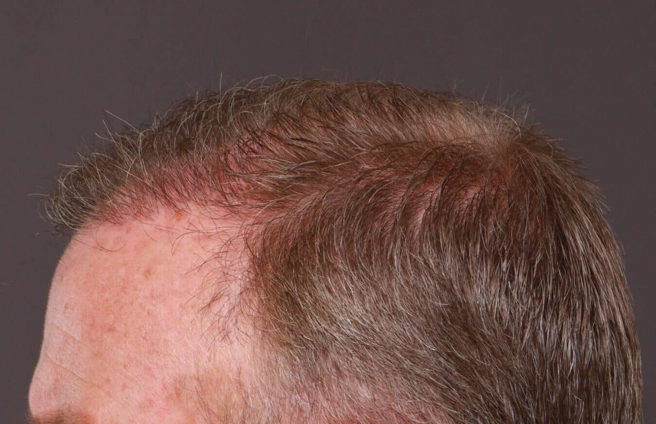 After Image: FUT Hair Transplant by Dr. Manning -