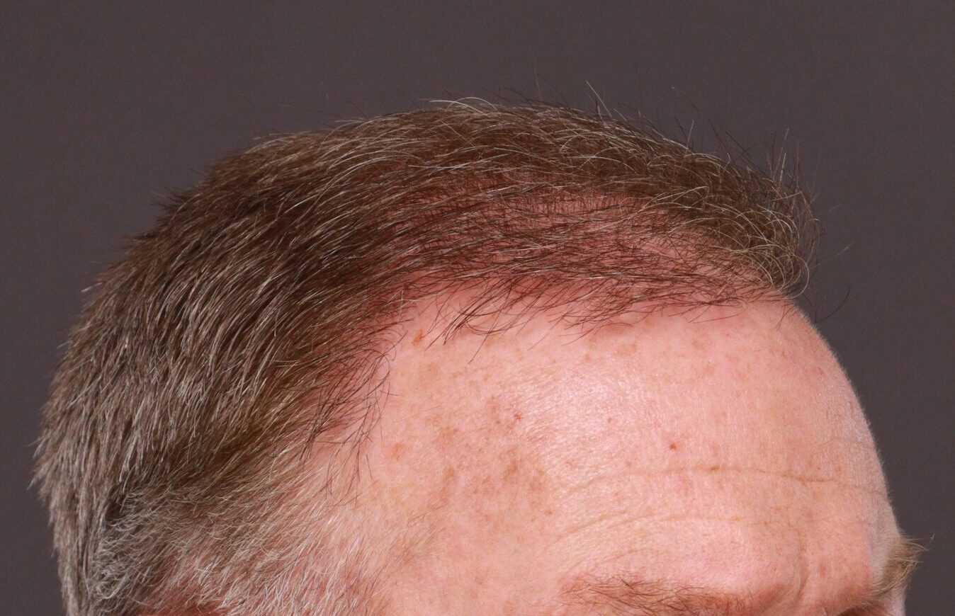 After Image: FUT Hair Transplant by Dr. Manning - right-front-oblique