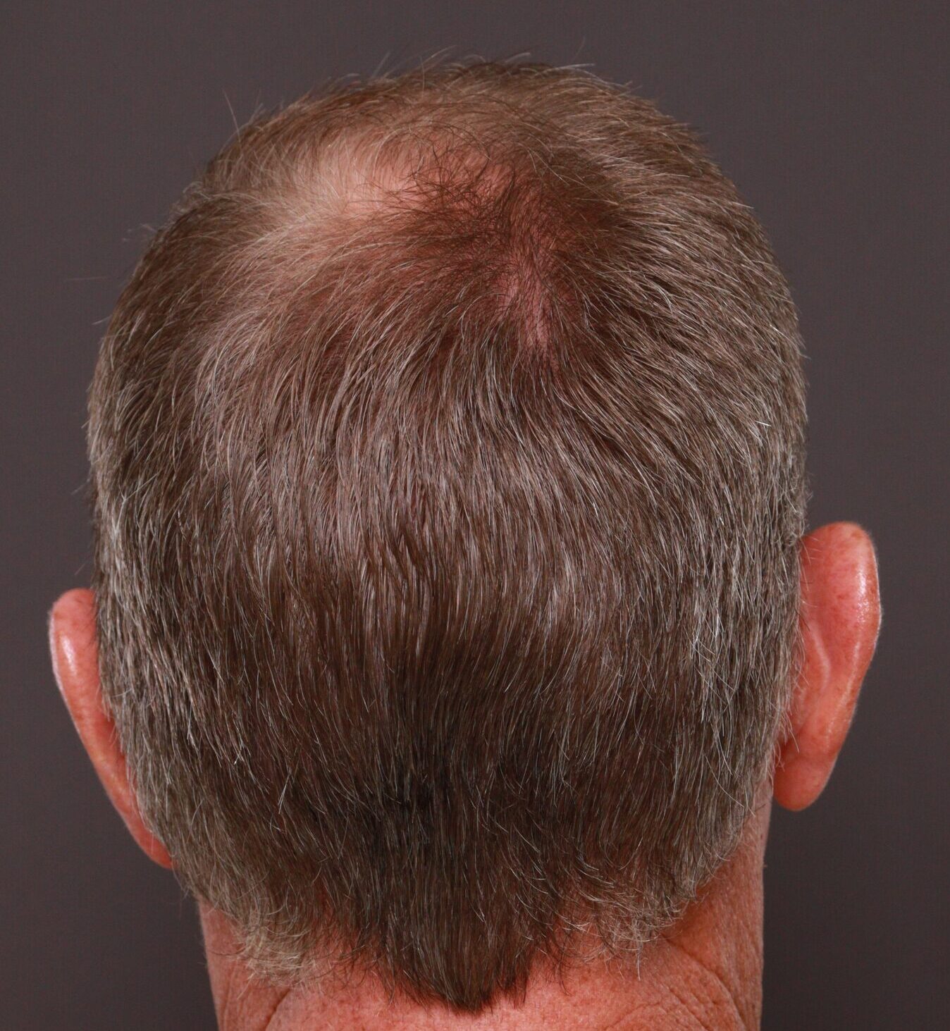 After Image: FUT Hair Transplant by Dr. Manning - front