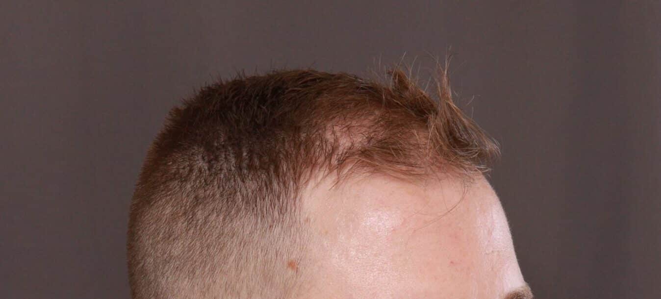 Before Image: FUE Hair Transplant by Dr. Thompson - right-front-oblique