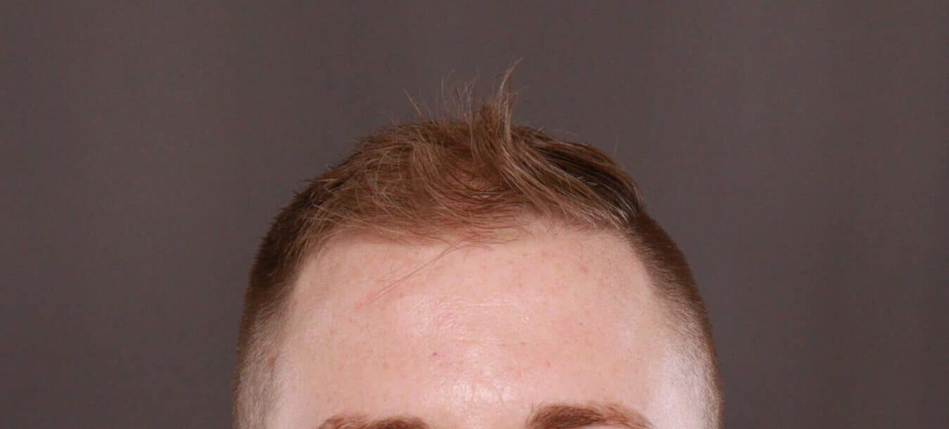 Before Image: FUE Hair Transplant by Dr. Thompson - front