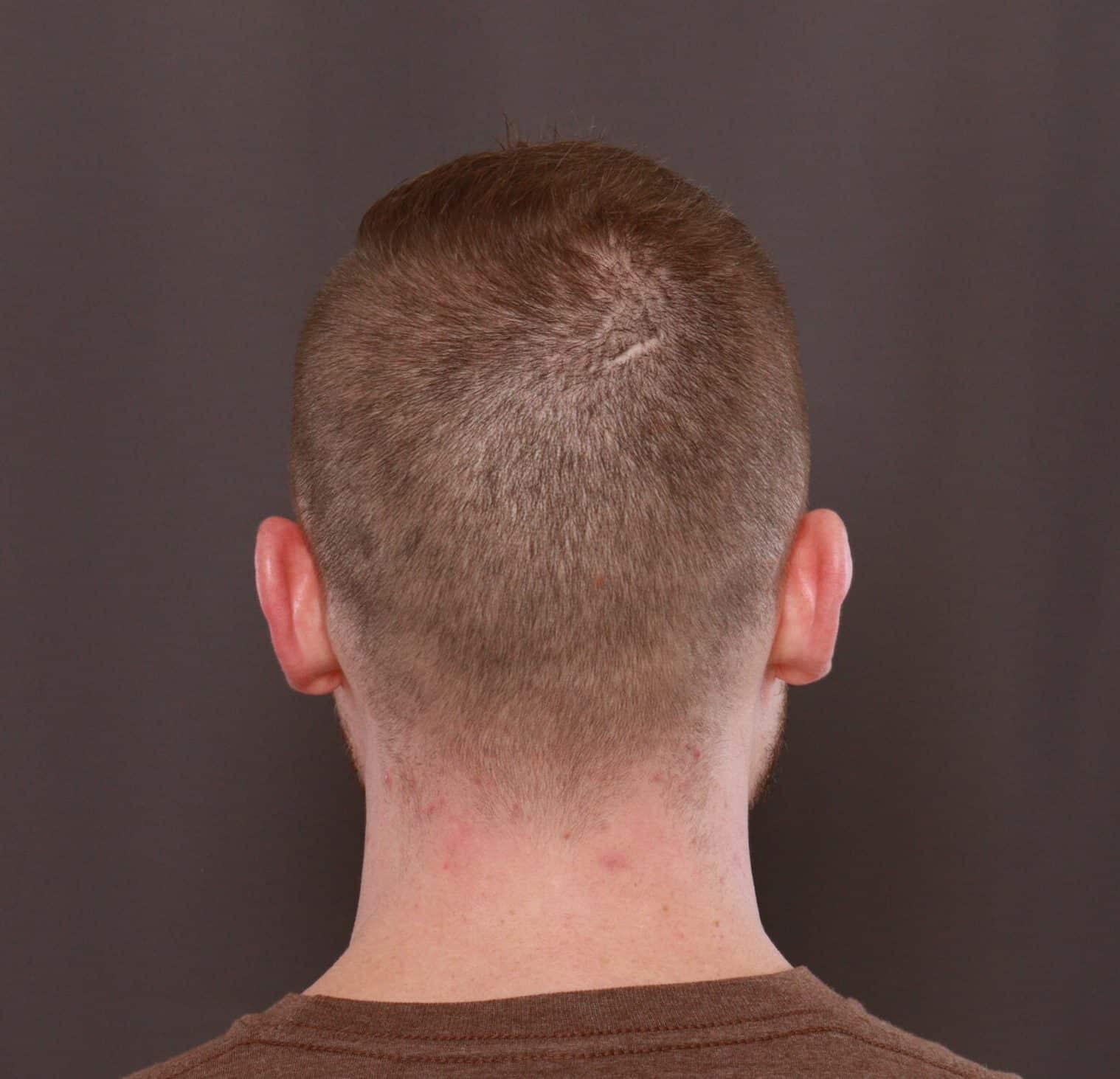 Before Image: FUE Hair Transplant by Dr. Thompson - back