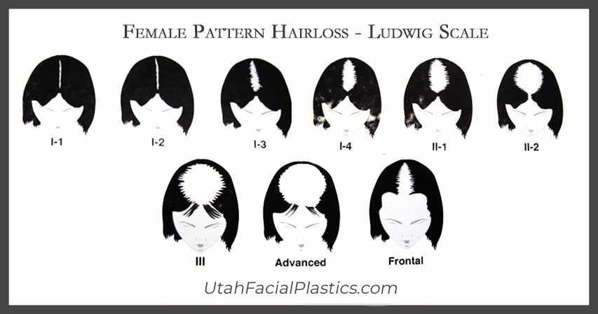 female pattern hair loss scale (1)