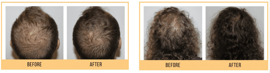 keravive before and after 2 Before after Keravive Scalp Treatment Roy & Draper UT