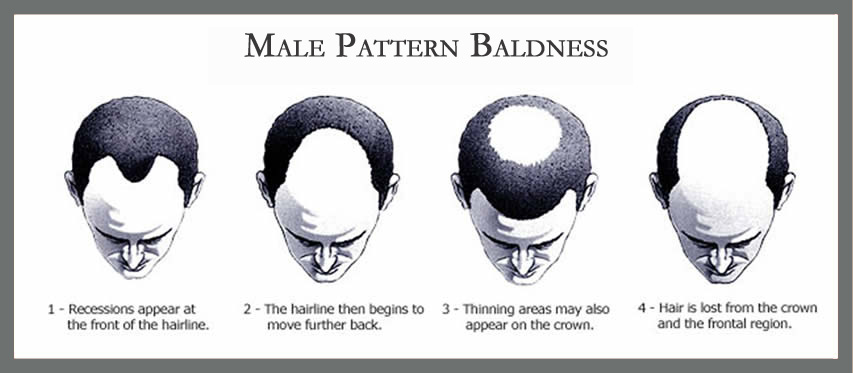male pattern baldness scale (1)