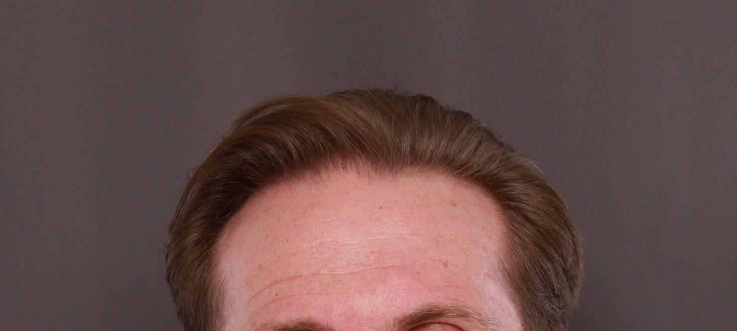 Before Image: FUE Hair Transplant by Dr. Thompson - front