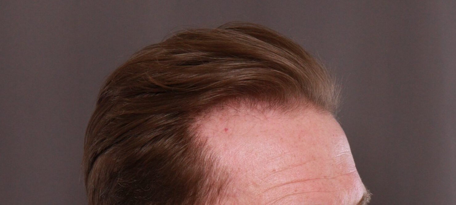 Before Image: FUE Hair Transplant by Dr. Thompson - right-front-oblique