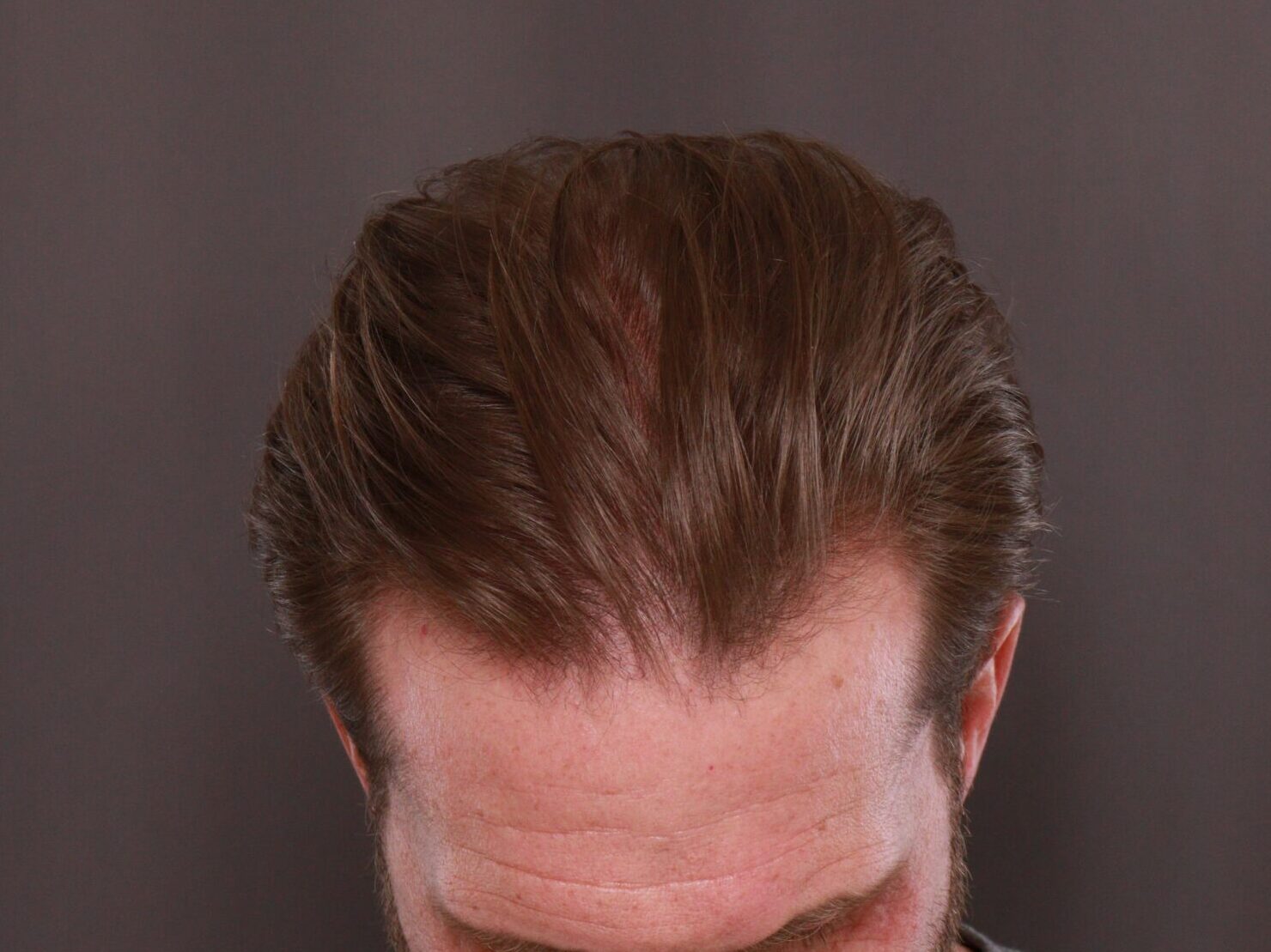 Before Image: FUE Hair Transplant by Dr. Thompson - front