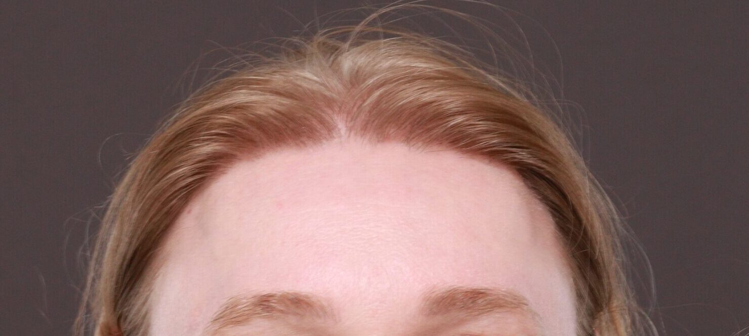 After Image: FUT Hair Transplant by Dr. Thompson - front