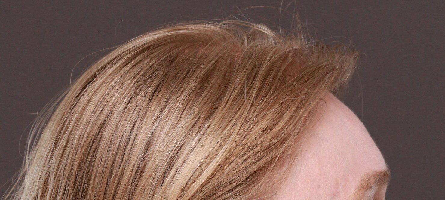 After Image: FUT Hair Transplant by Dr. Thompson -
