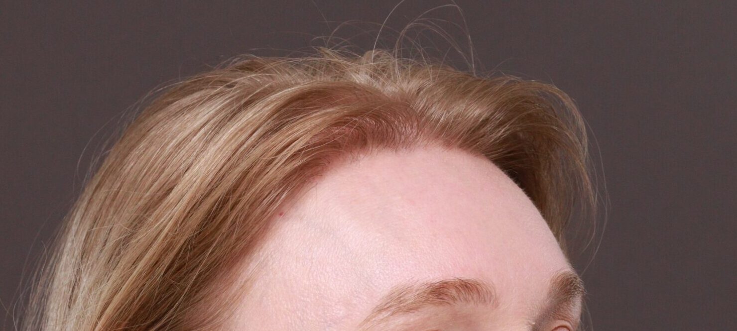 After Image: FUT Hair Transplant by Dr. Thompson - right-front-oblique