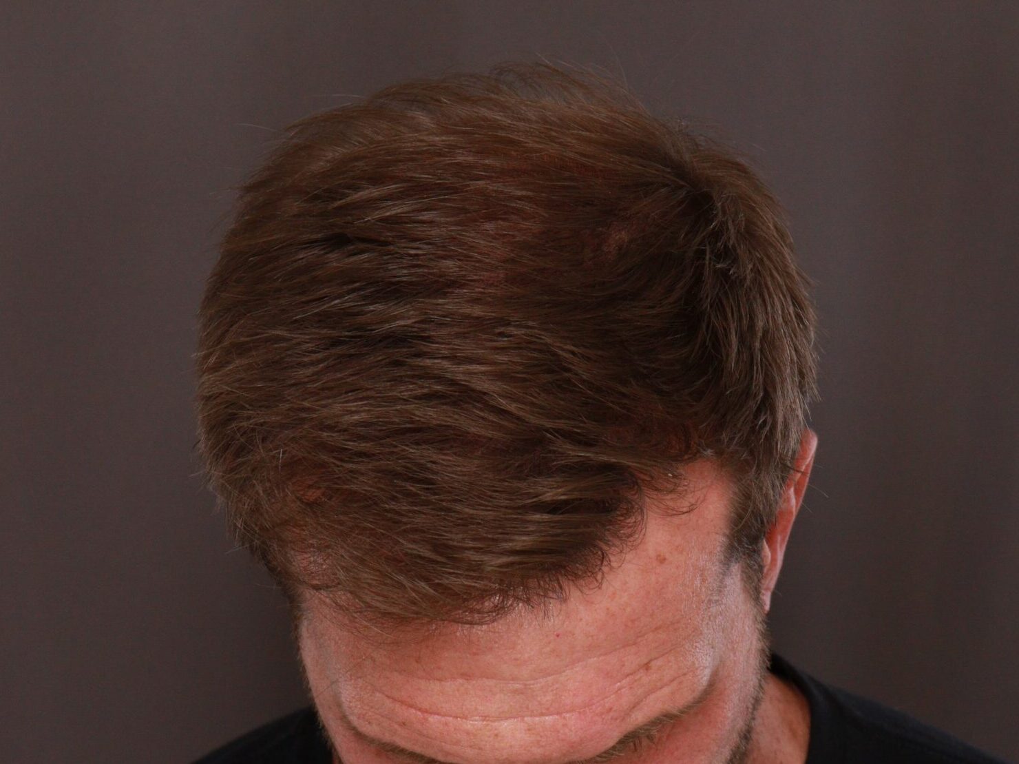 After Image: FUE Hair Transplant by Dr. Thompson - front