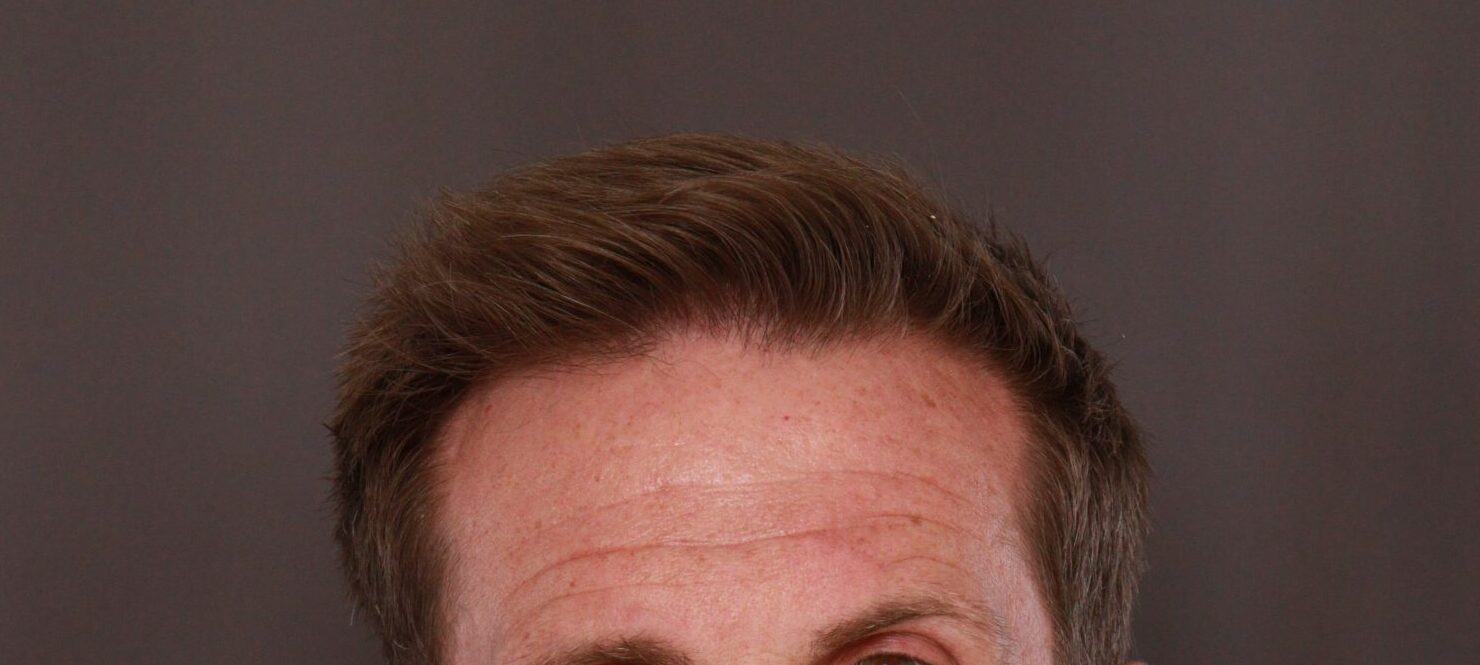 After Image: FUE Hair Transplant by Dr. Thompson - front