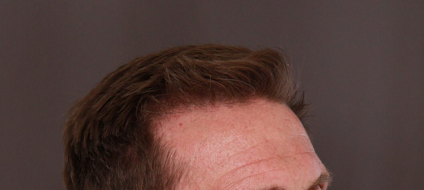 After Image: FUE Hair Transplant by Dr. Thompson - right-front-oblique