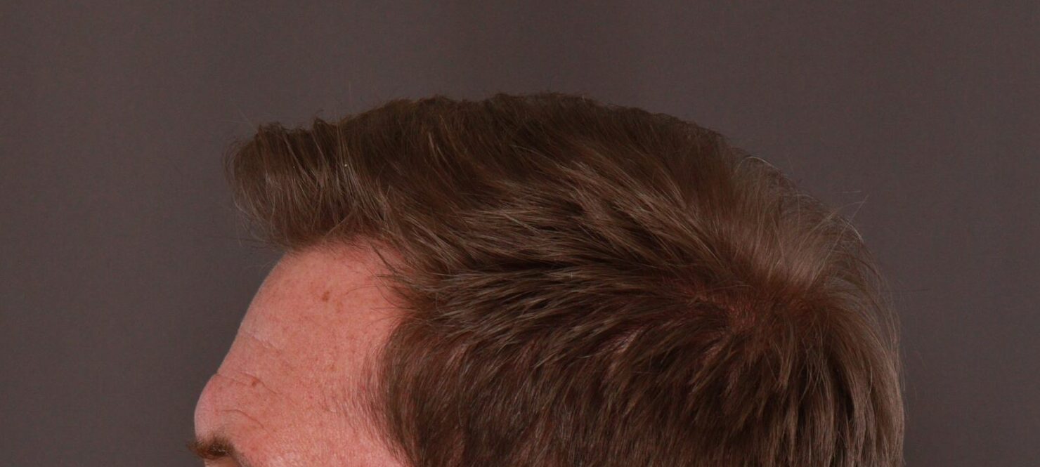After Image: FUE Hair Transplant by Dr. Thompson - left-side