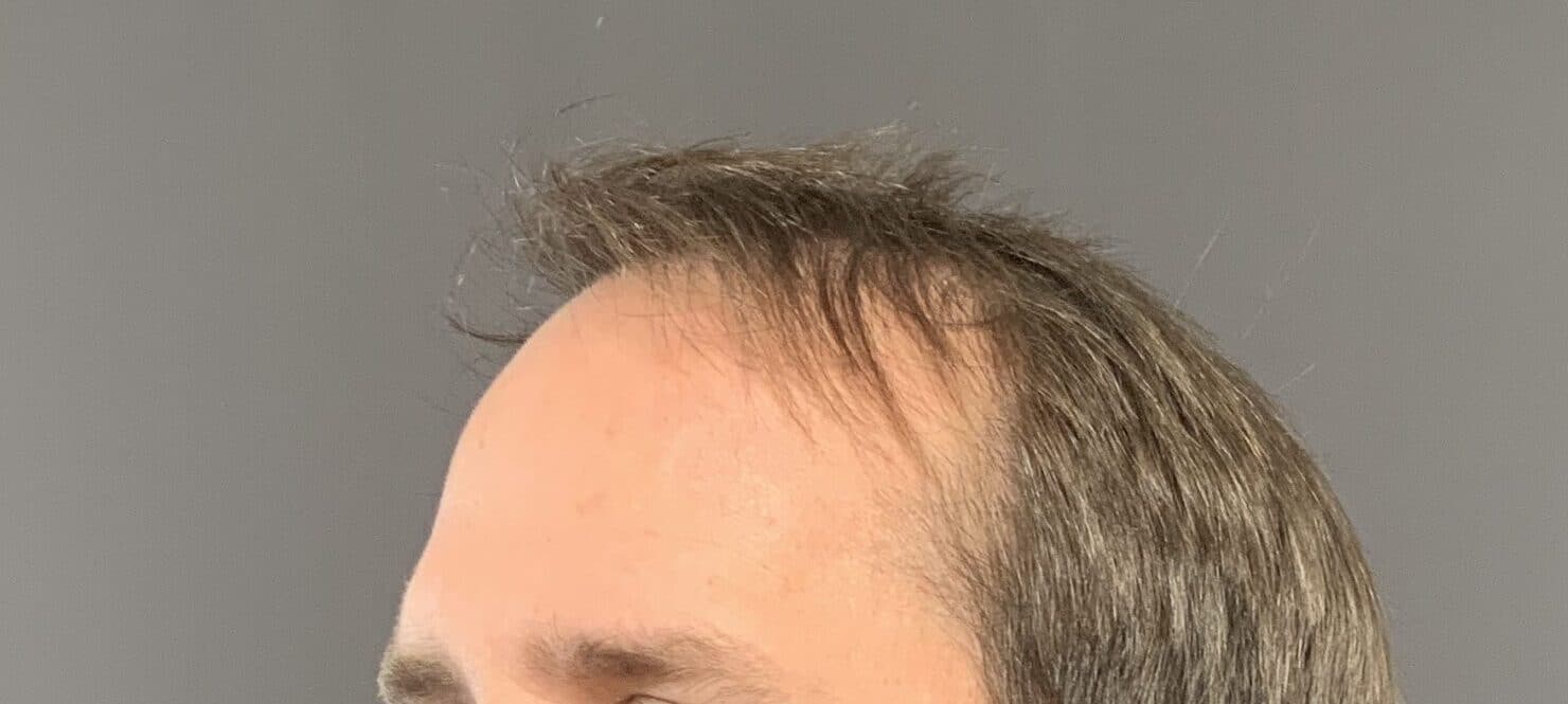 Before Image: FUT Hair Transplant by Dr. Manning - left-front-oblique
