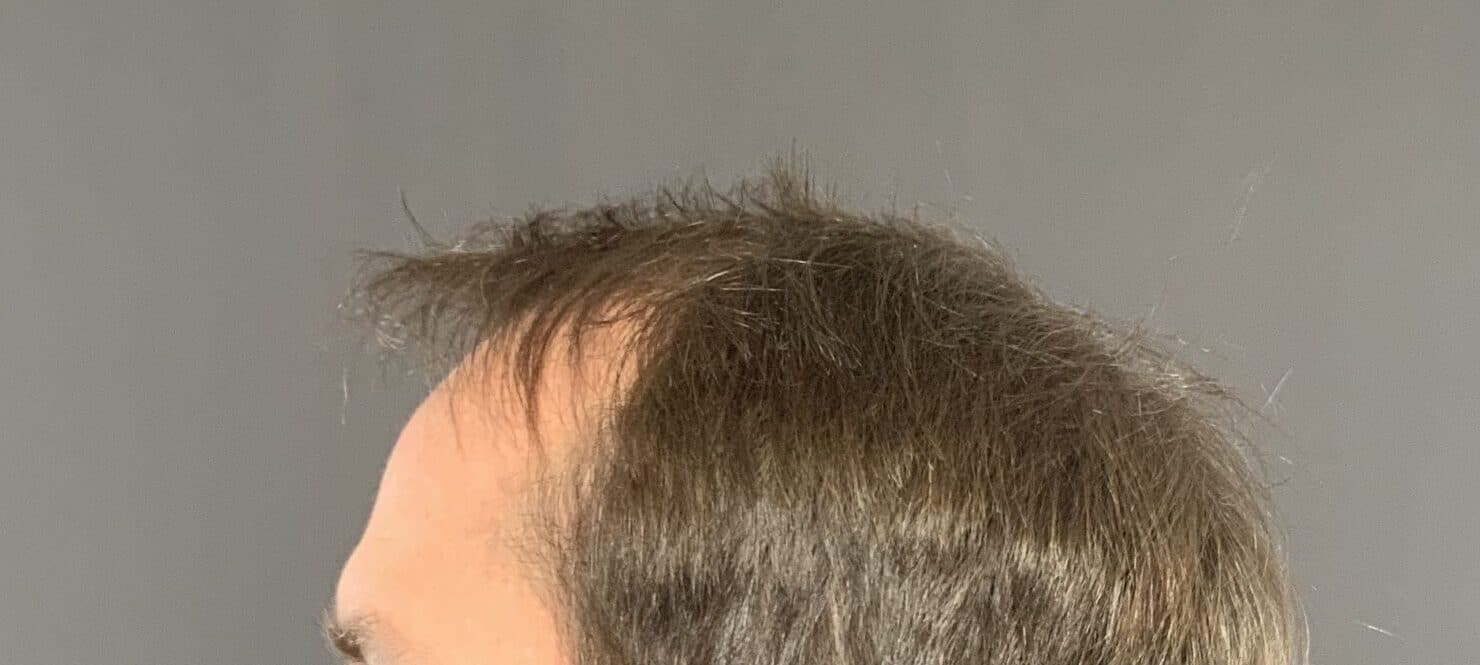 Before Image: FUT Hair Transplant by Dr. Manning - left-side