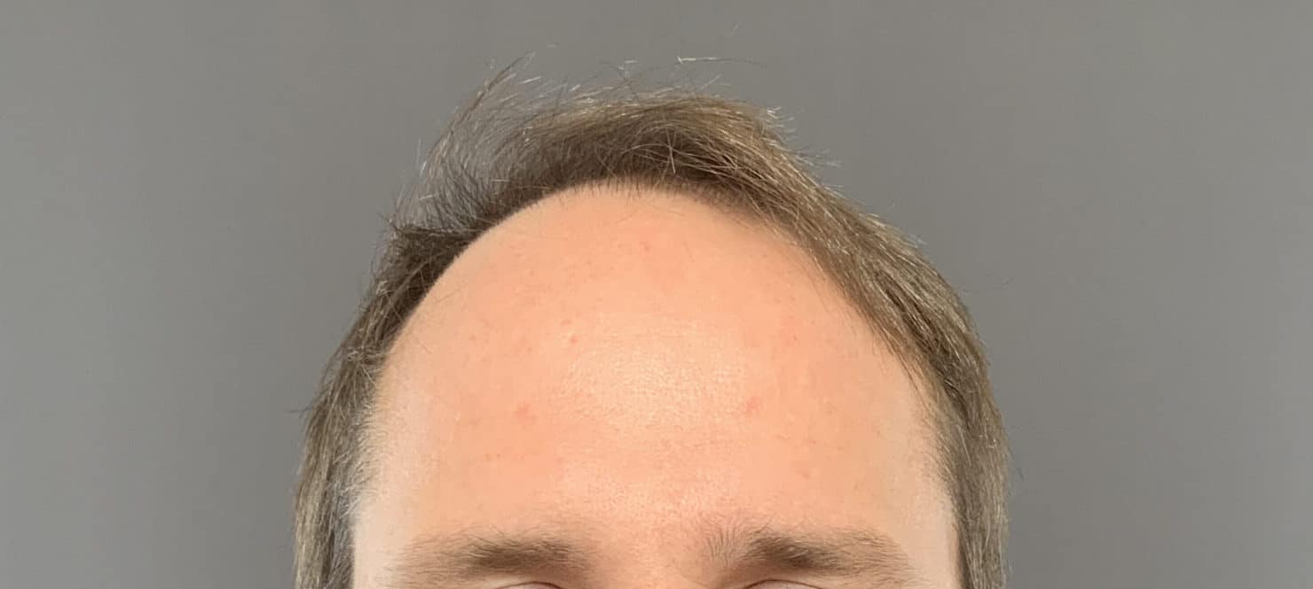 Before Image: FUT Hair Transplant by Dr. Manning - front