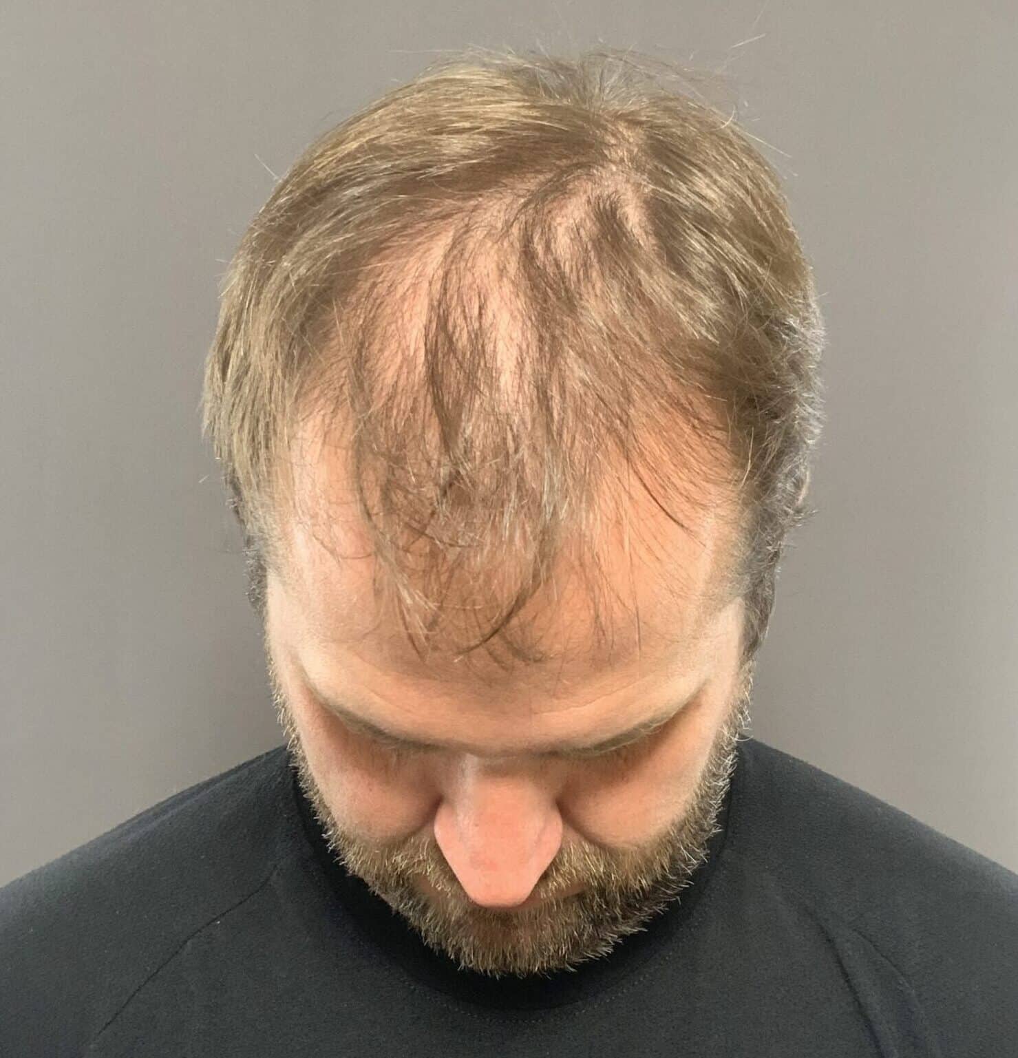 Before Image: FUT Hair Transplant by Dr. Manning - front