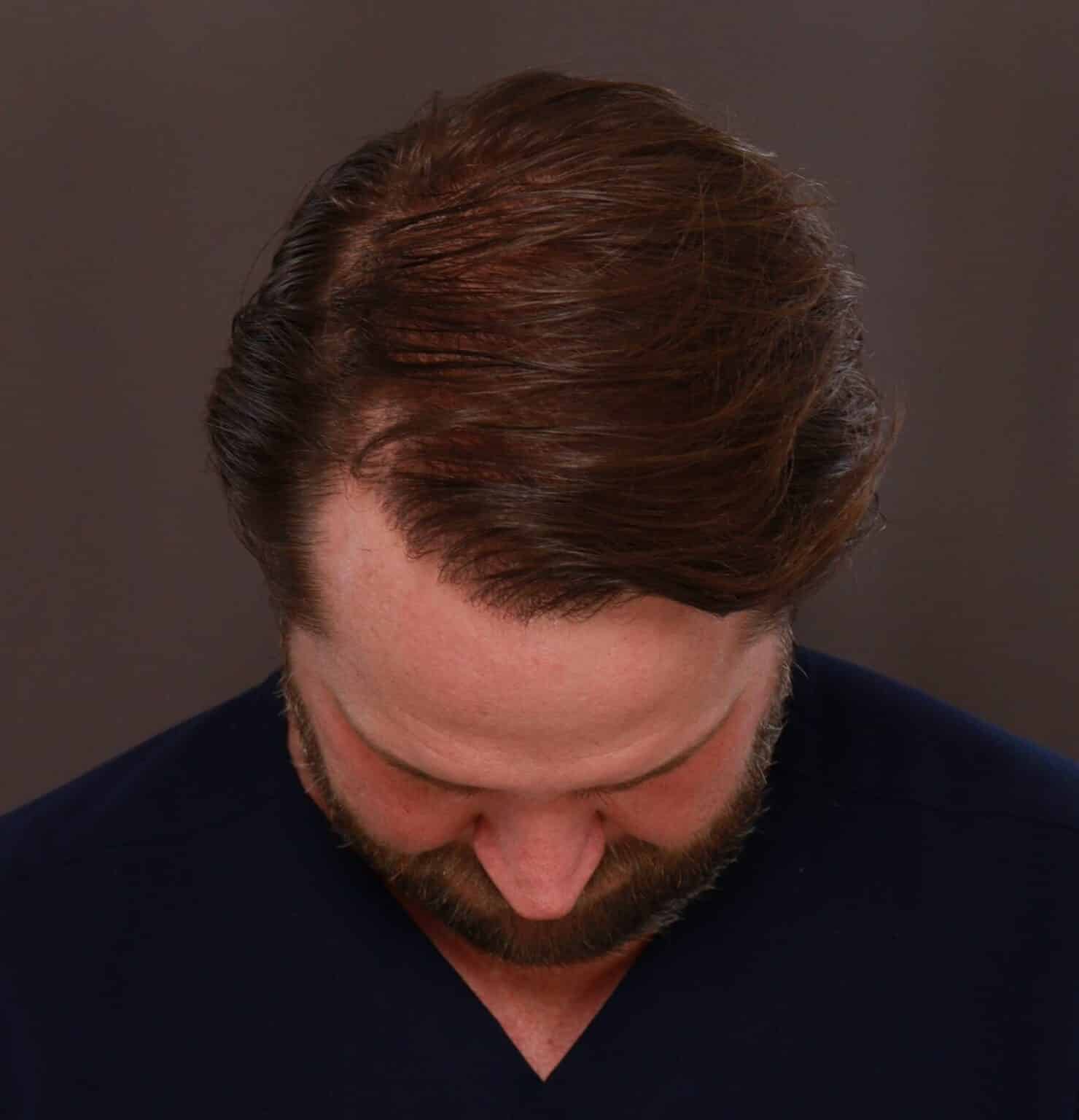 After Image: FUT Hair Transplant by Dr. Manning - front