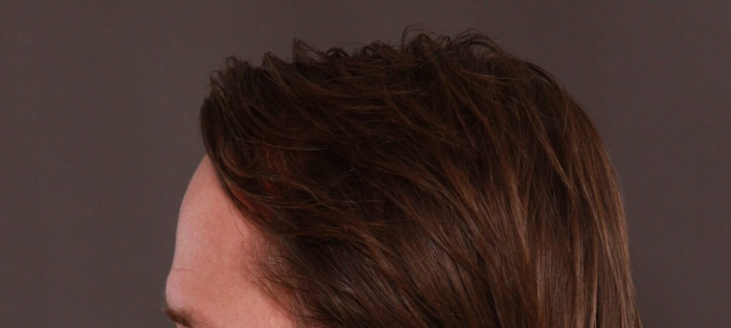 After Image: FUT Hair Transplant by Dr. Manning - left-side