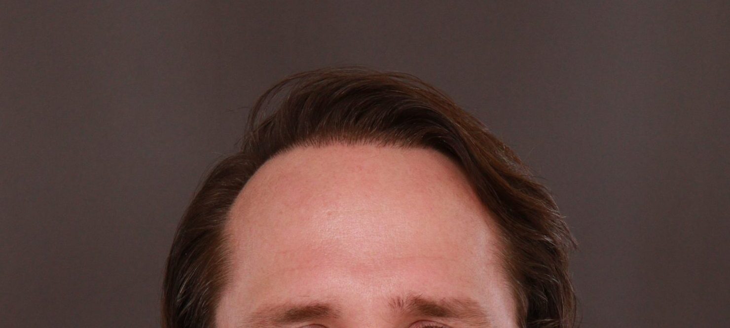 After Image: FUT Hair Transplant by Dr. Manning - front