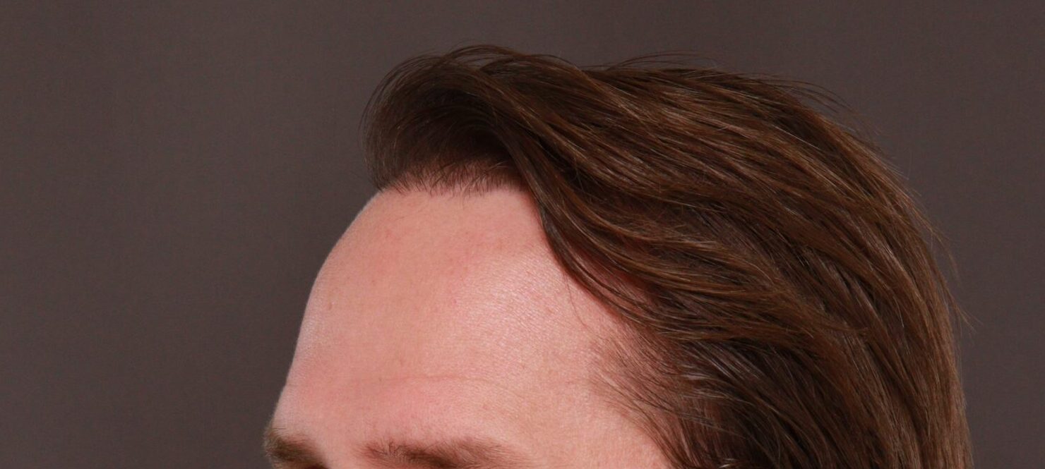 After Image: FUT Hair Transplant by Dr. Manning - left-front-oblique