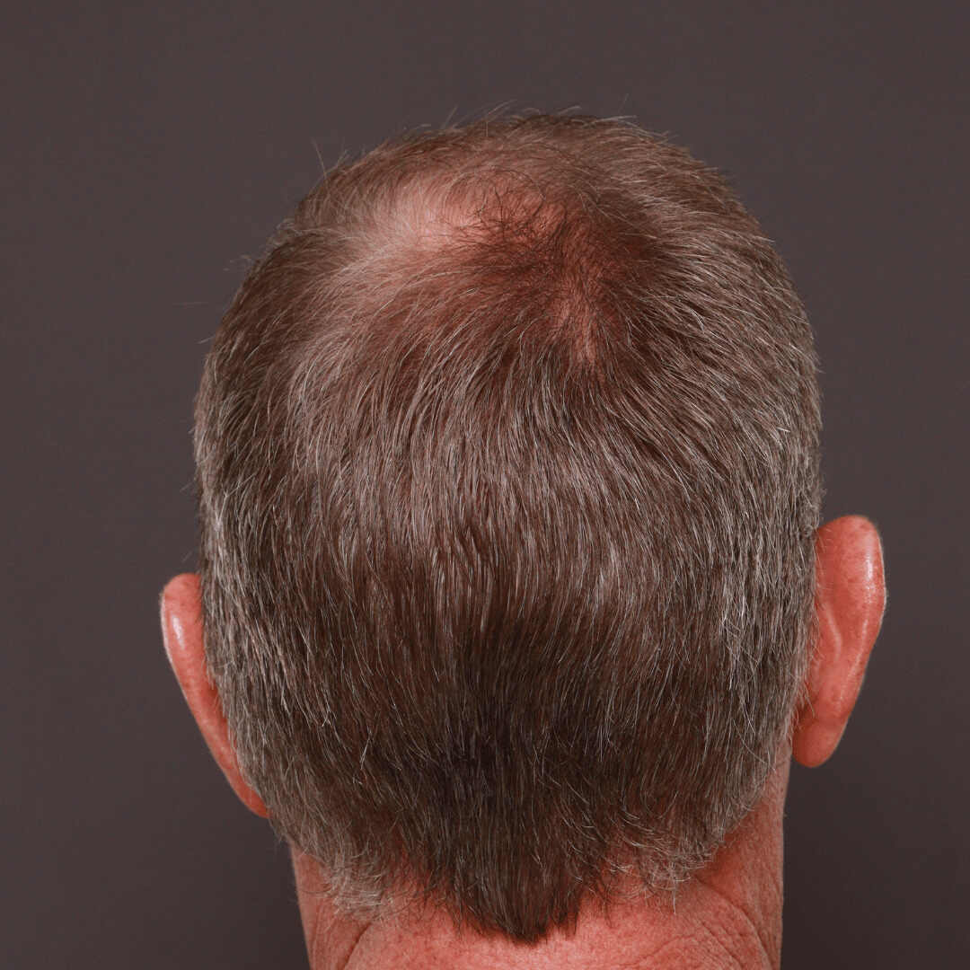 Strip method Hair Transplants Roy & Draper UT 2