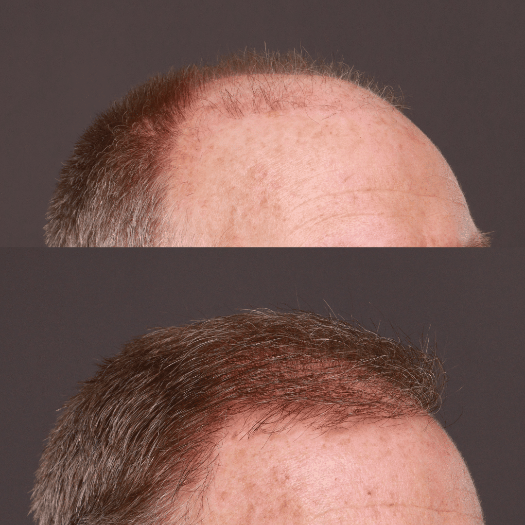 Before after FUT or Strip Method Hair Transplants Roy & Draper UT 2