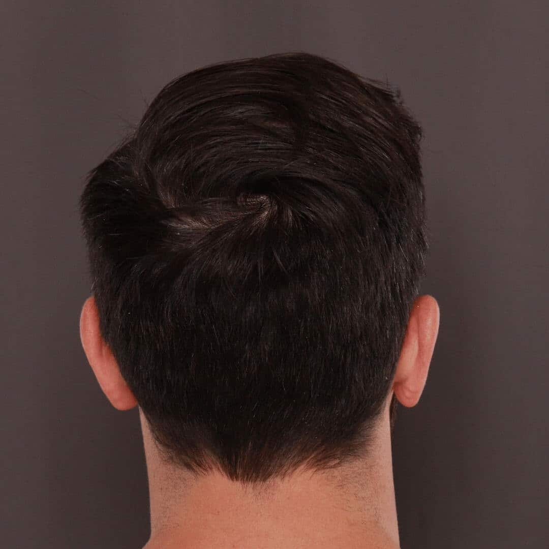 Strip method Hair Transplants Roy & Draper UT 1