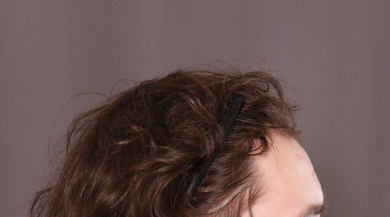 Before Image: FUE Hair Transplant by Dr. Henstrom - right-side