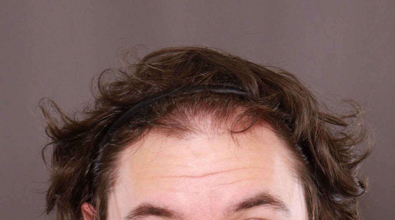 Before Image: FUE Hair Transplant by Dr. Henstrom - front