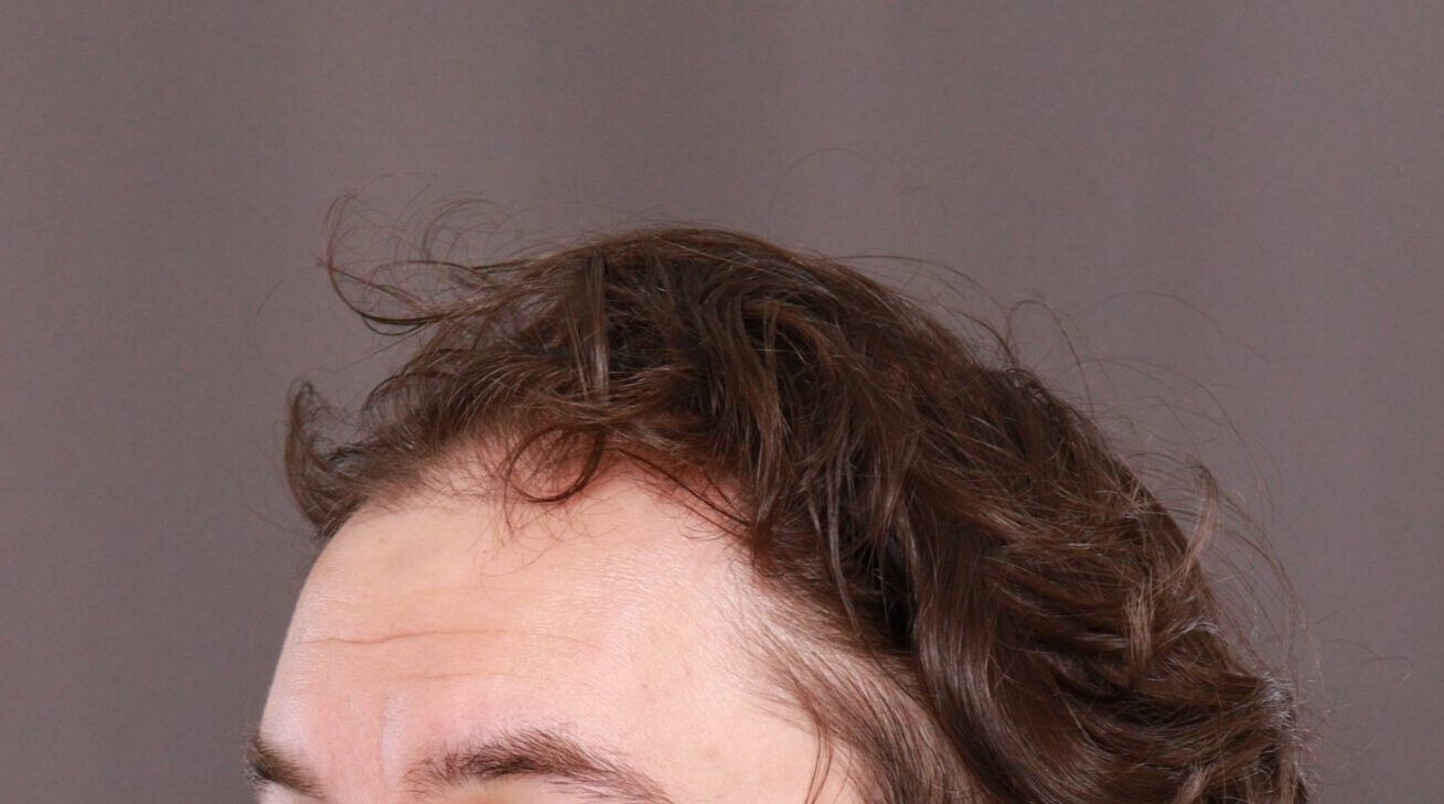 Before Image: FUE Hair Transplant by Dr. Henstrom - left-front-oblique