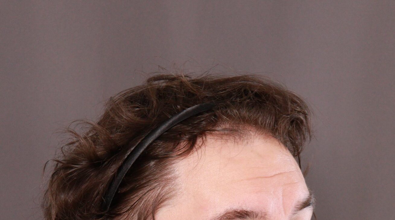 Before Image: FUE Hair Transplant by Dr. Henstrom - right-front-oblique