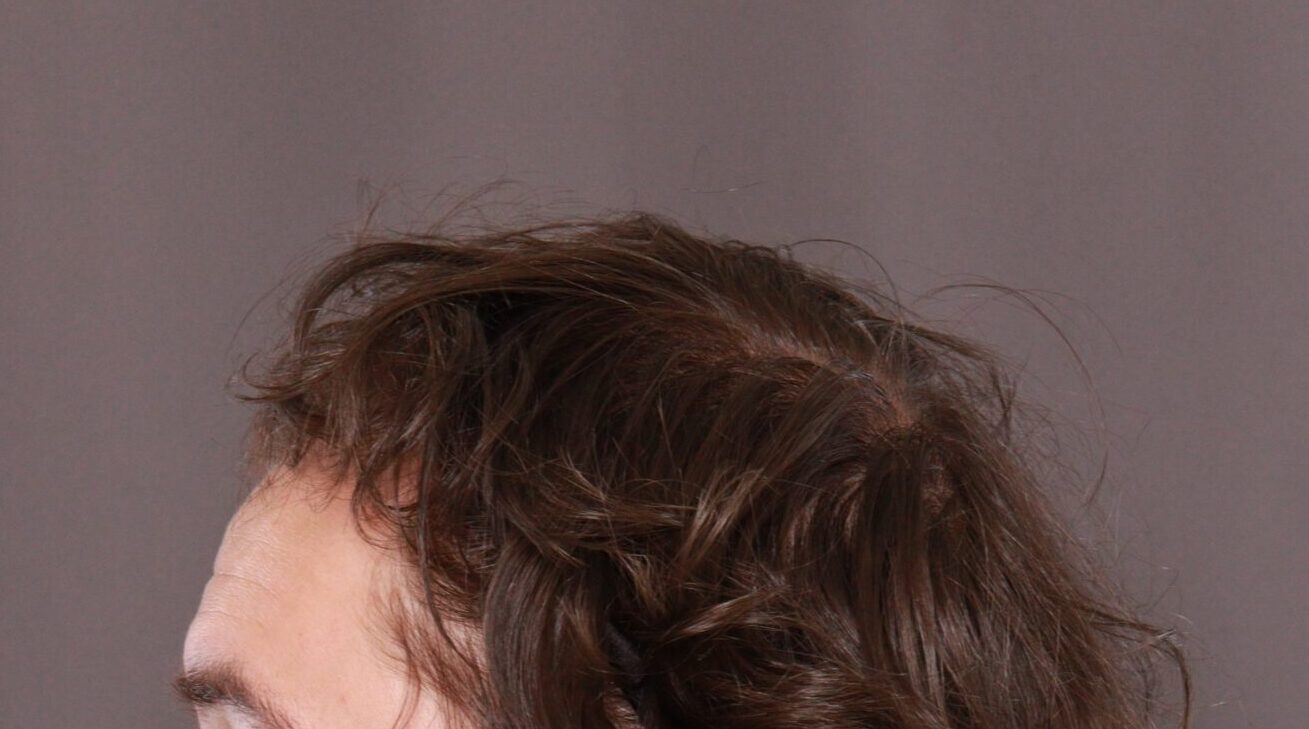 Before Image: FUE Hair Transplant by Dr. Henstrom - left-side
