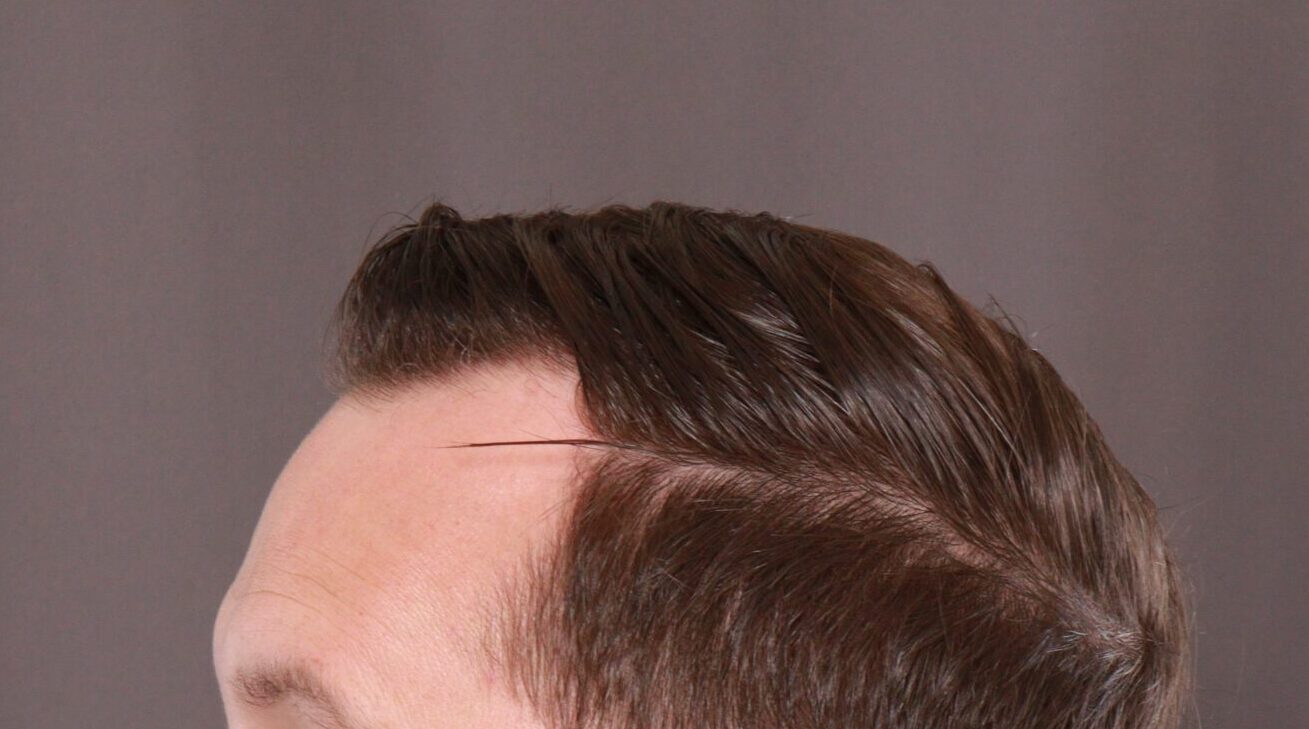 Before Image: FUE Hair Transplant by Dr. Henstrom - left-side